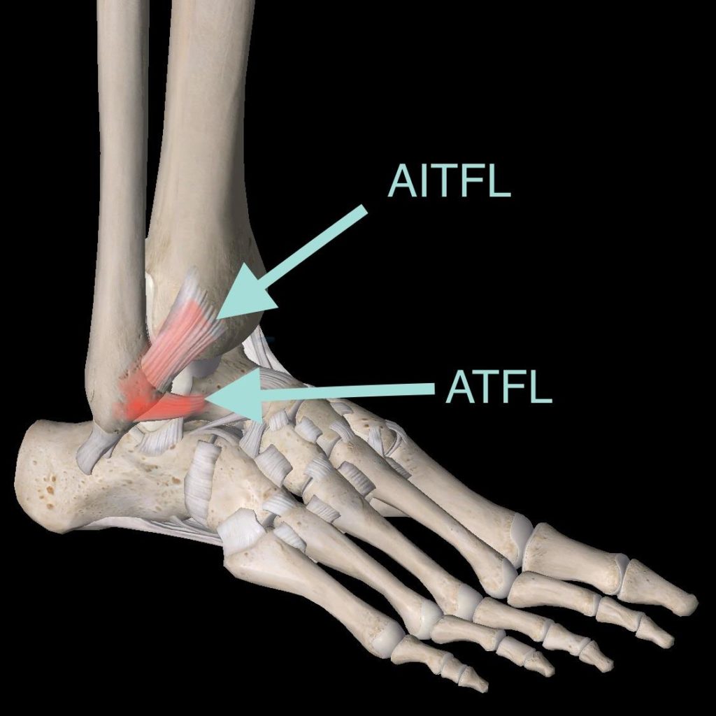 腳踝扭傷 翻腳刀時最常受傷的韌帶