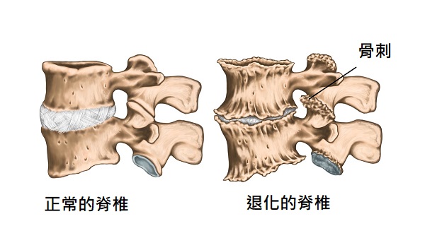 腰椎退化包含小面關節炎及長骨刺