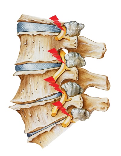 腰椎退化的骨刺會刺激到神經