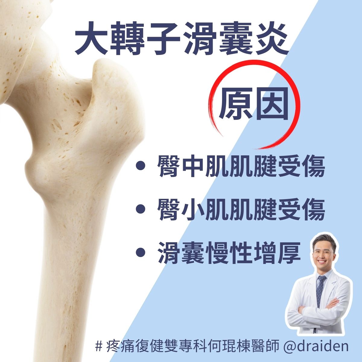 大轉子滑囊炎原因：臀中肌肌腱受傷、臀小肌肌腱受傷、慢性滑囊增厚