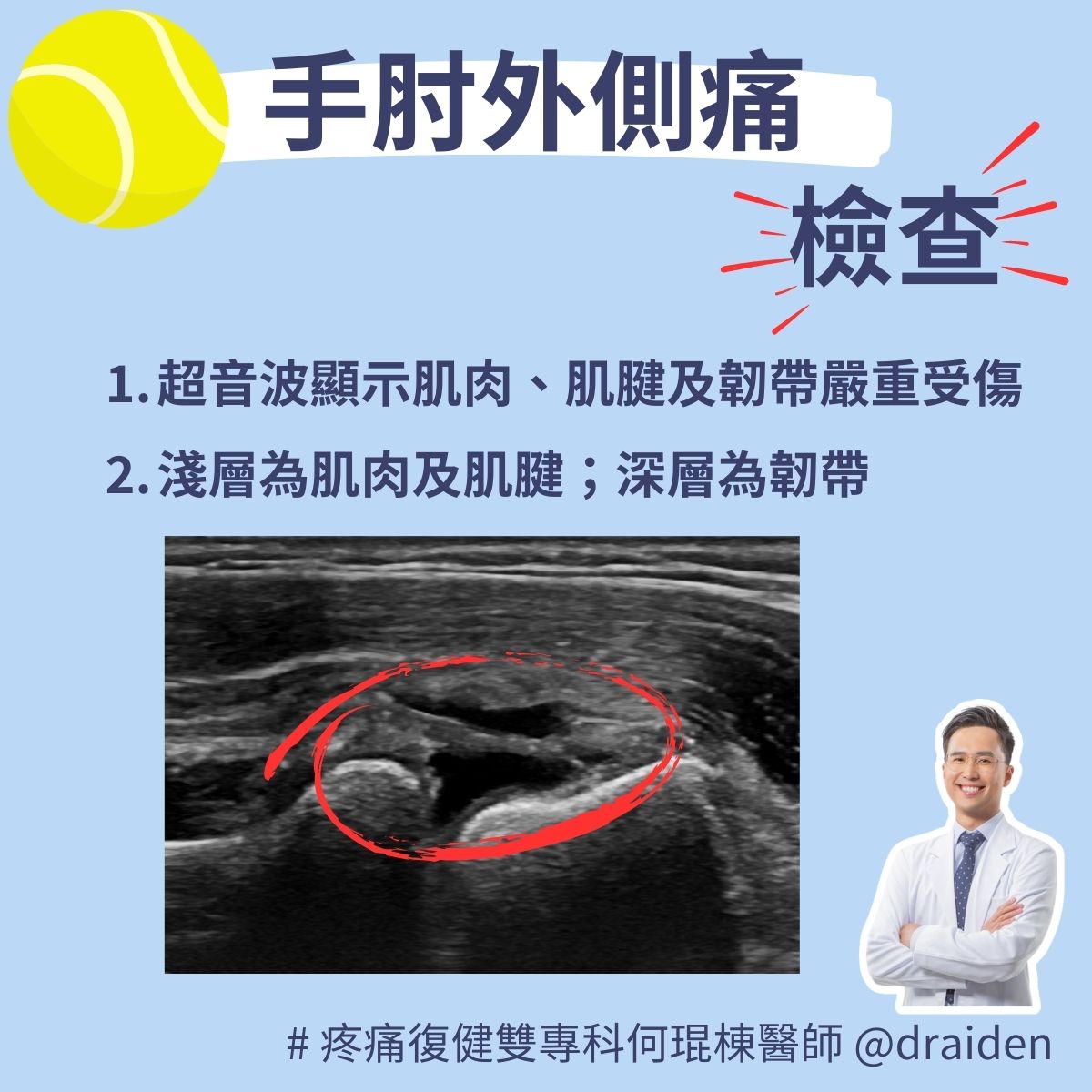 網球肘超音波檢查發現：嚴重的肌肉、肌腱及韌帶受傷