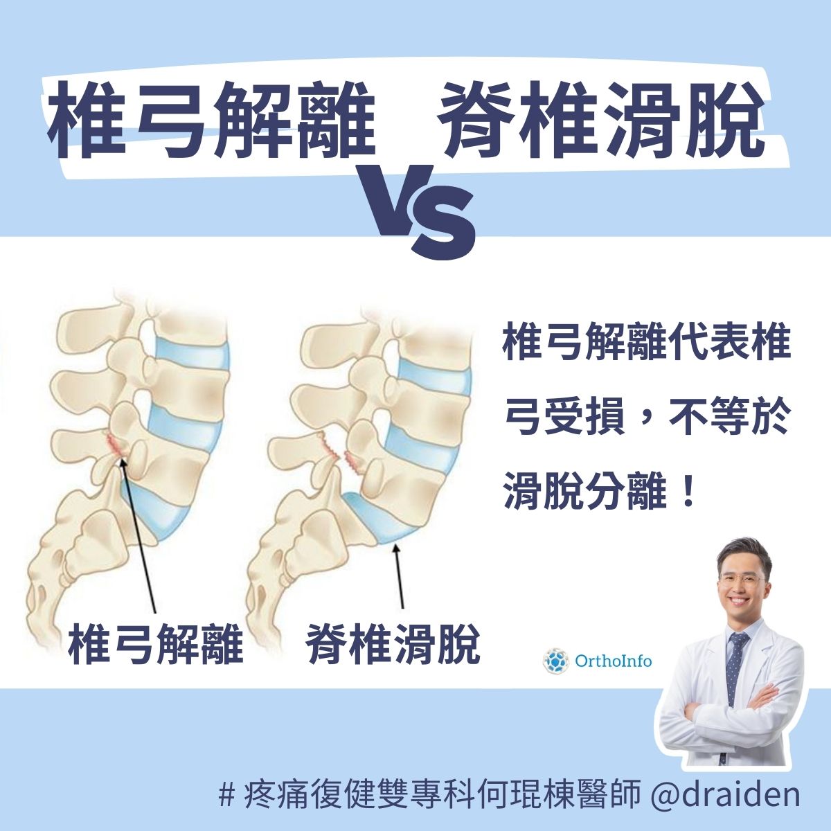 椎弓解離代表椎弓受損，不等於脊椎滑脫分離！