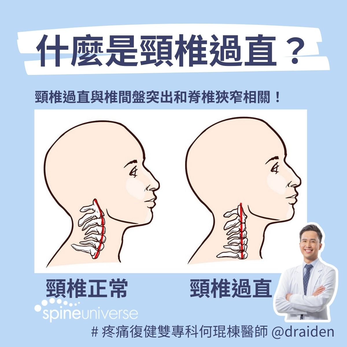 頸椎過直與頸椎間盤突出及脊椎狹窄相關