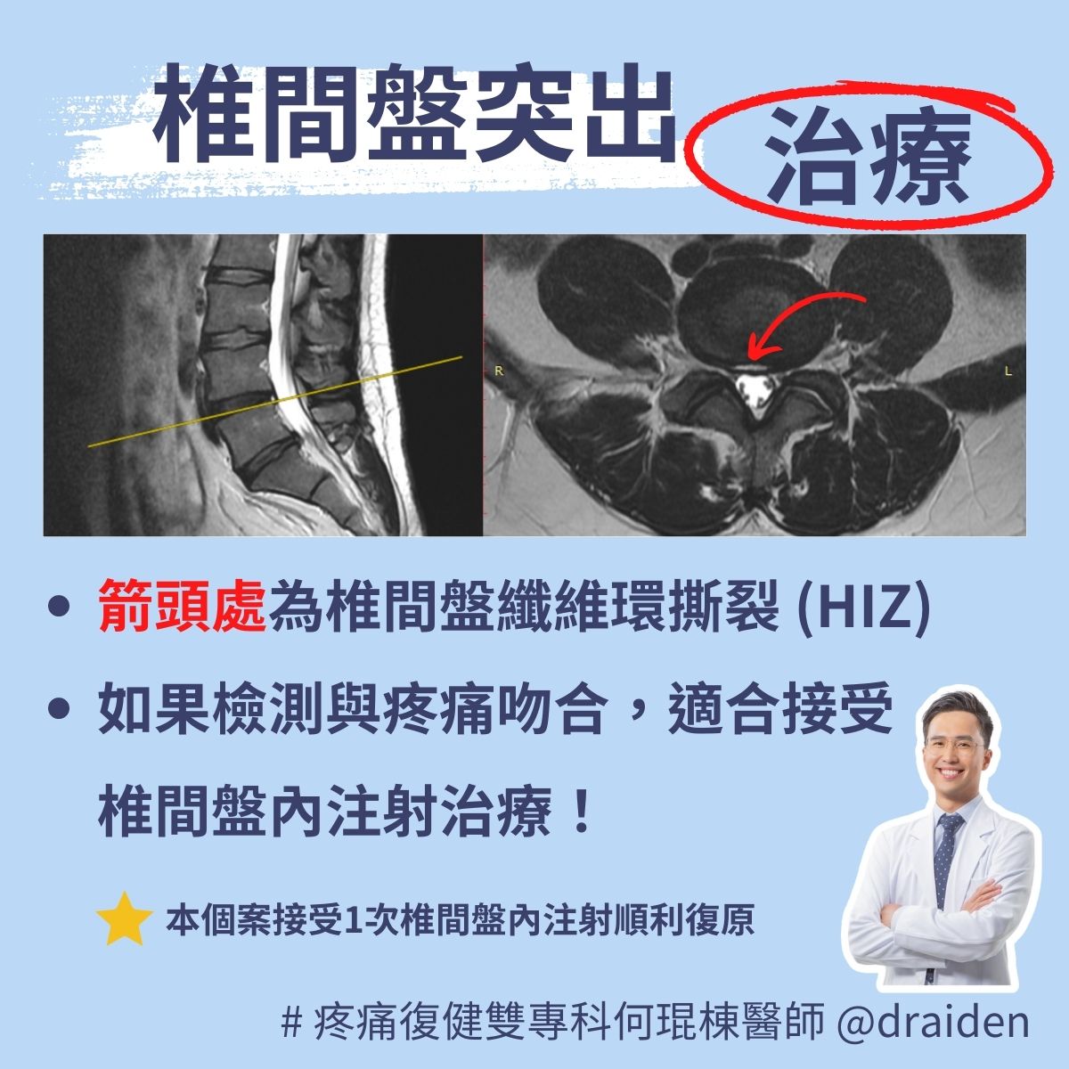 椎間盤纖維環撕裂治療，High Intensity Zone (HIZ) treatment